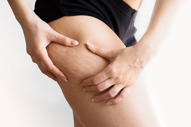 eliminar-grasa-abdominal-caceres-celulitis-piel-naranja