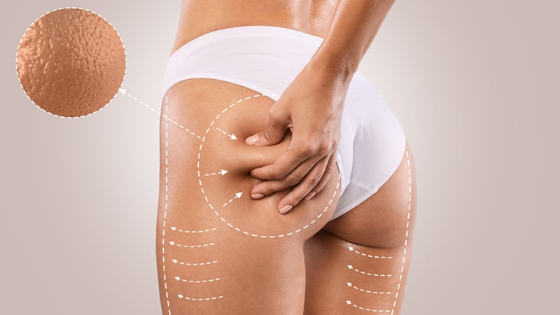 eliminar-grasa-abdominal-caceres-celulitis